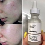 سرم ضد جوش نیاسینامید 10% + زینک 1% اوردینری - تصویر 4